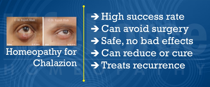 Homeopathy for Chalazion